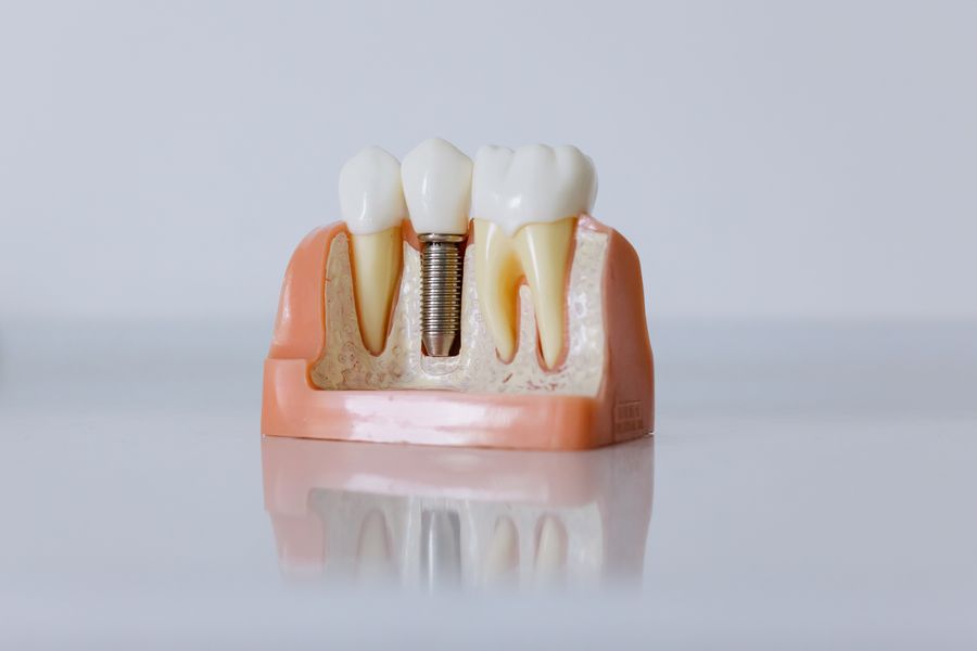 Maqueta dental de un implante